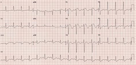 Ecg In Brugada
