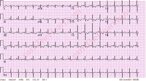 Ecg Right Heart Strain