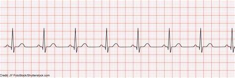 Ecg Strip