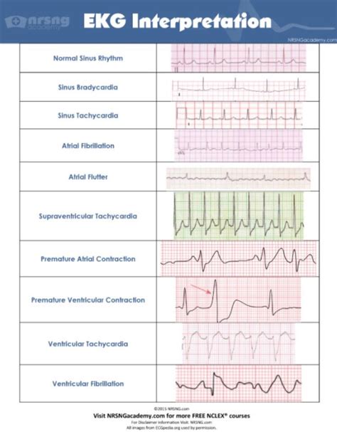 Ecg Strips