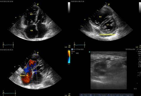 Echo Heart Failure