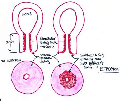 Ectropion Of Cervix Uteri