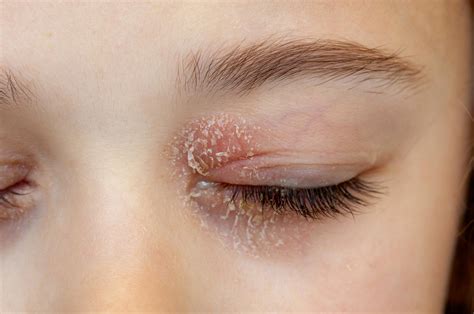 Eczema On Eyelids Cure