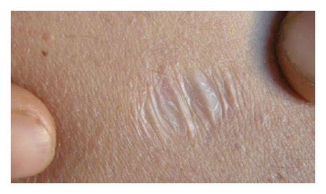 Ehlers Danlos Syndrome Scar