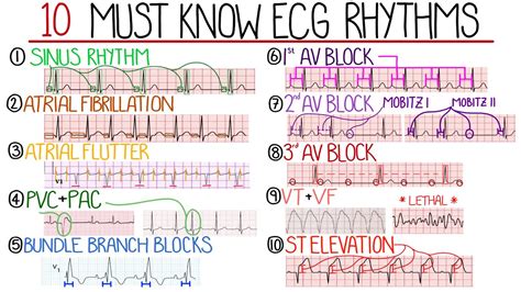 Ekg Rhythms