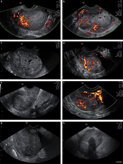 Endometrial Cancer Ultrasound