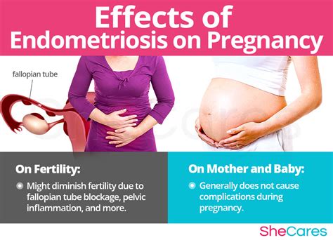 Endometriosis Does It Affect Pregnancy