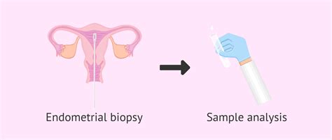 Endometrium Biopsy Pain