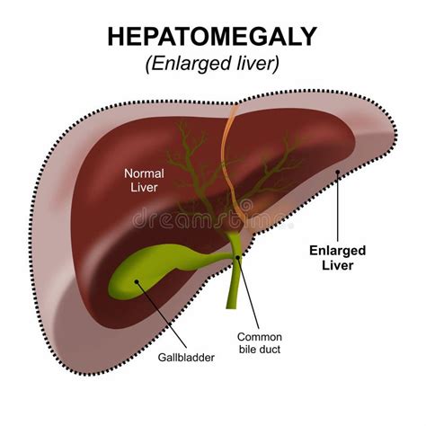 Enlargement Of The Liver