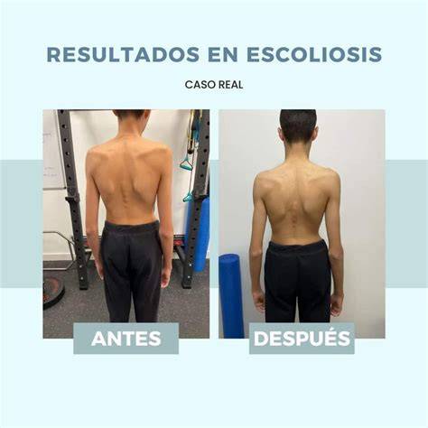 Escoliosis En Adultos