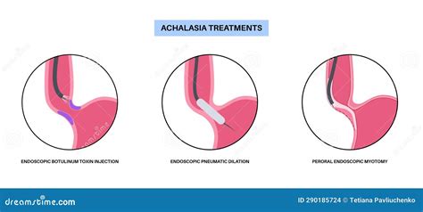 Esophageal Achalasia Treatment