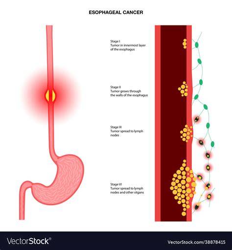 Esophageal Cancer Stages