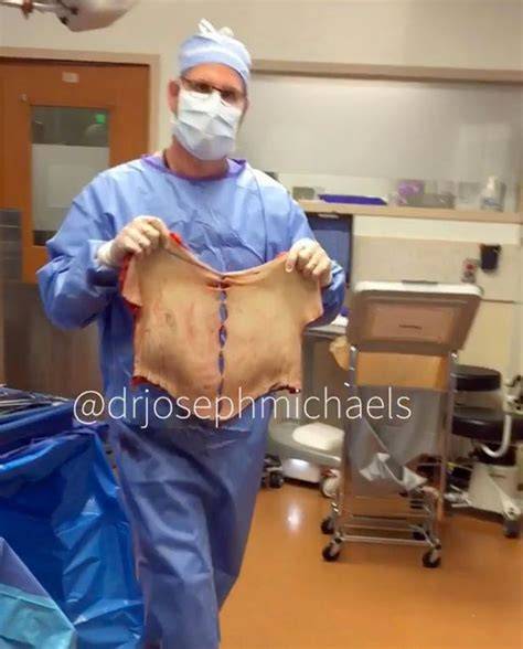 Excess Skin Removal Surgery