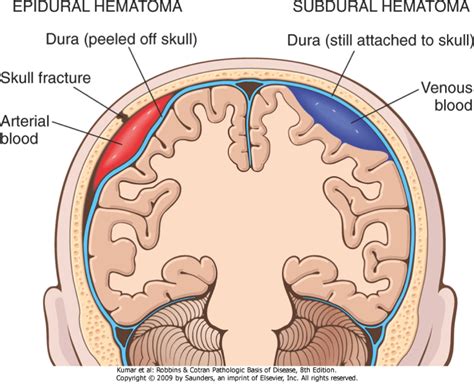 Extradural Haematoma Vs Subdural