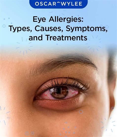 Eye Allergy Treatment At Home