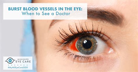 Eye Blood Vessel Burst
