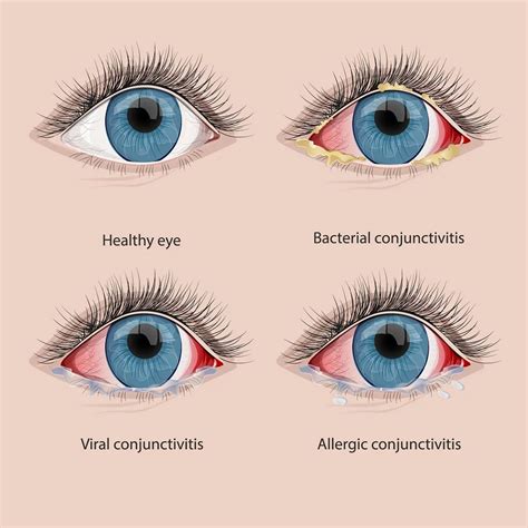 Eye Cold Symptoms