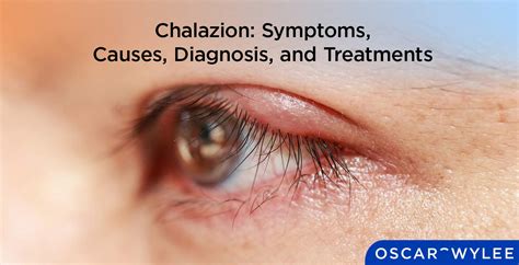 Eye Doctor Chalazion