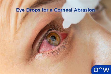 Eye Drops For Scratched Cornea