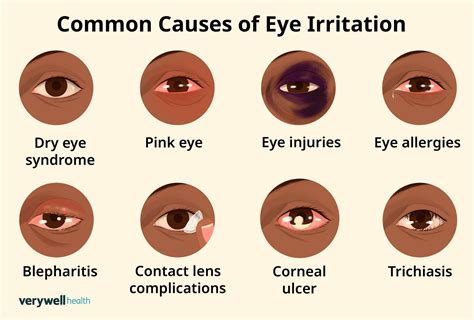Eye Irritation Treatment