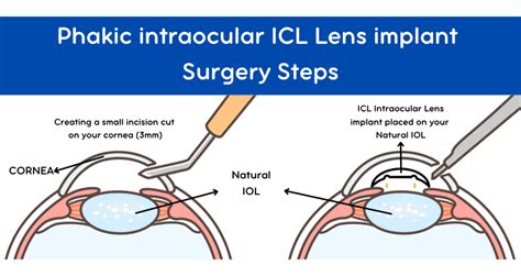 Eye Lens Replacement Surgery