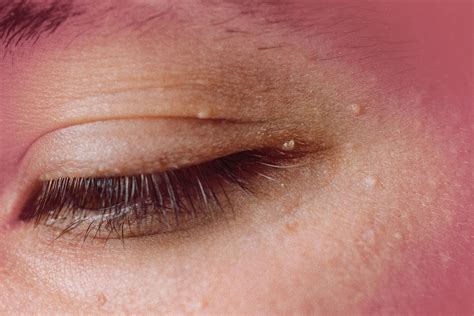 Eyelid Little Bump