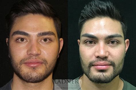 Face Before And After Plastic Surgery