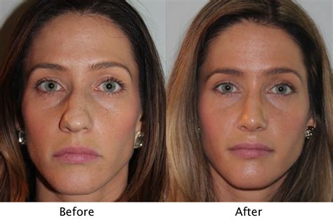 Face Before And After Sinus Surgery