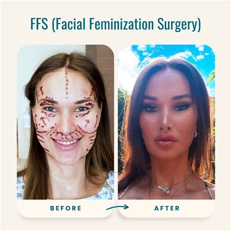 Face Feminization Surgery Before And After