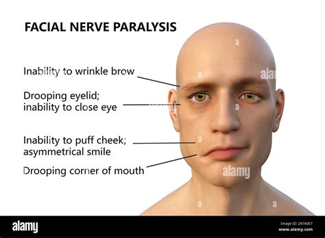 Facial Paralysis Causes