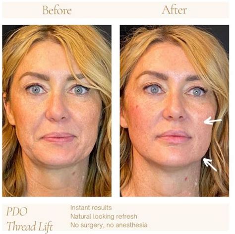 Facial Threads Facelift