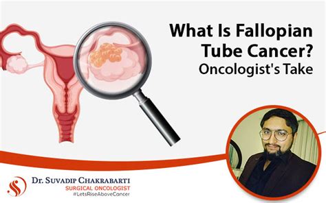 Fallopian Tube Cancer