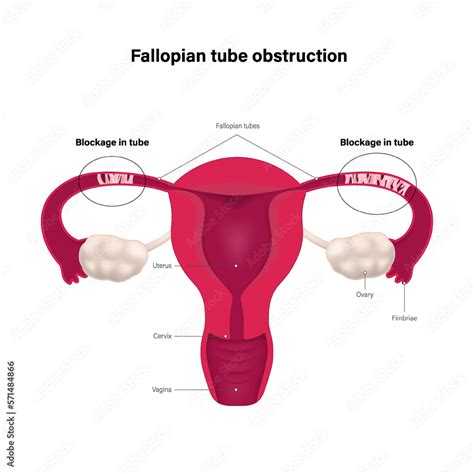 Fallopian Tube Uterine Tube