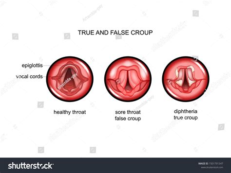 False Vocal Folds