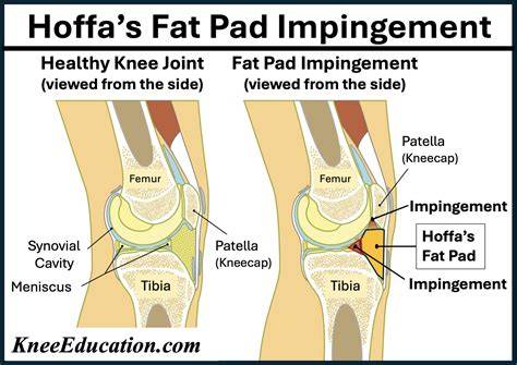 Fat Pad Impingement