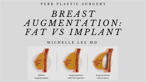 Fat Transfer Breast Augmentation