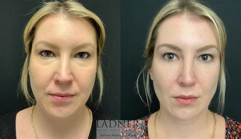 Fat Transfer To Face