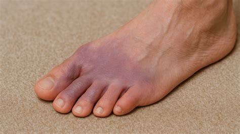 Feet Turning Purple When Sitting