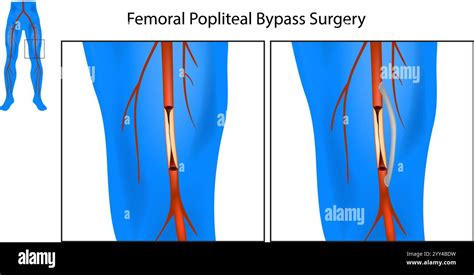 Fem Pop Bypass