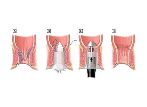 Female Hemorrhoidectomy Surgery
