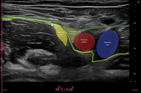 Femoral Nerve Block