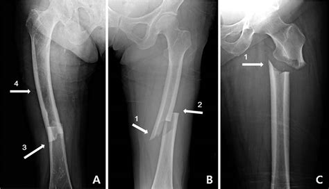 Femur Bone Break