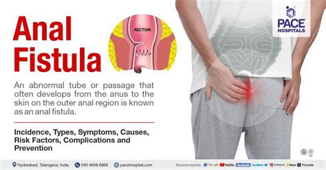 Fistula Rectal Symptoms