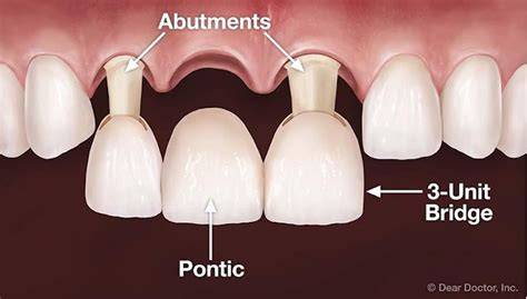 Fixed Bridge Dental