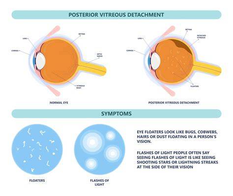 Flashes Of Light In Eye