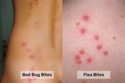 Flea Bites Newborn