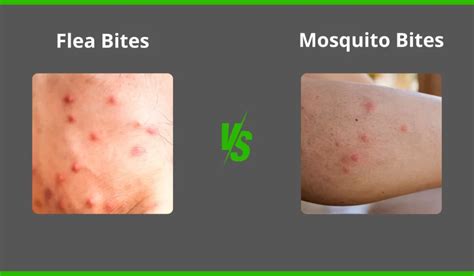 Flea Bites Vs Mosquito