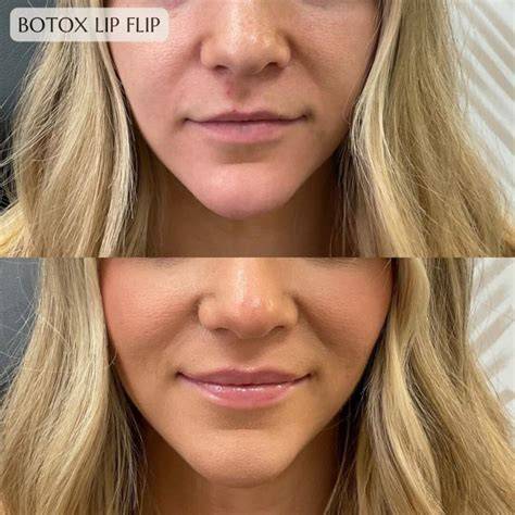 Flip Lip Botox