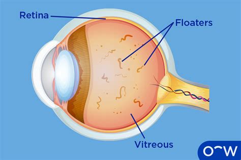 Floaters In The Eyes