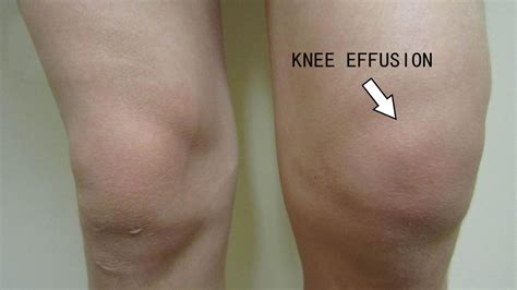 Fluid On The Knee